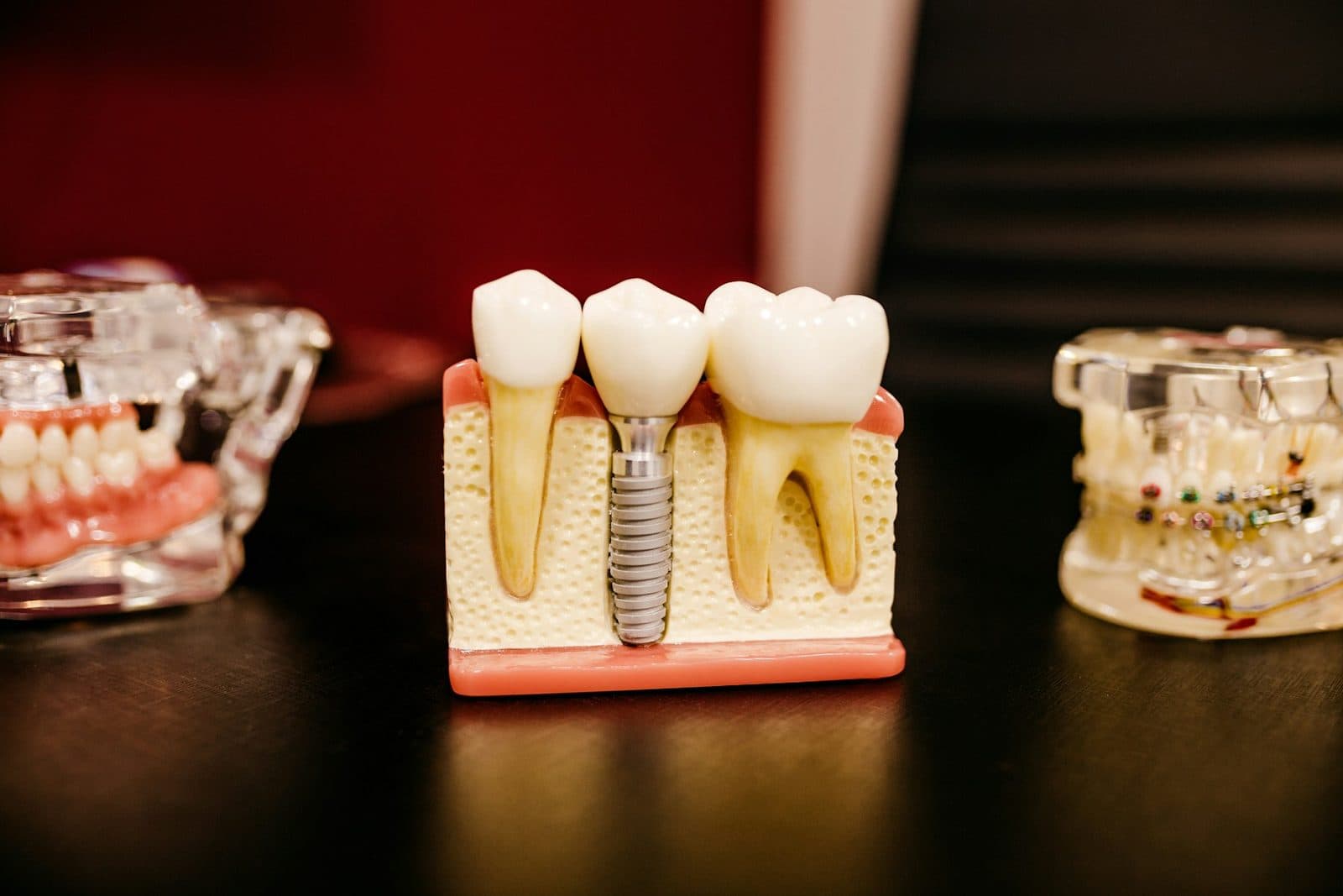 4 Implants + Crowns